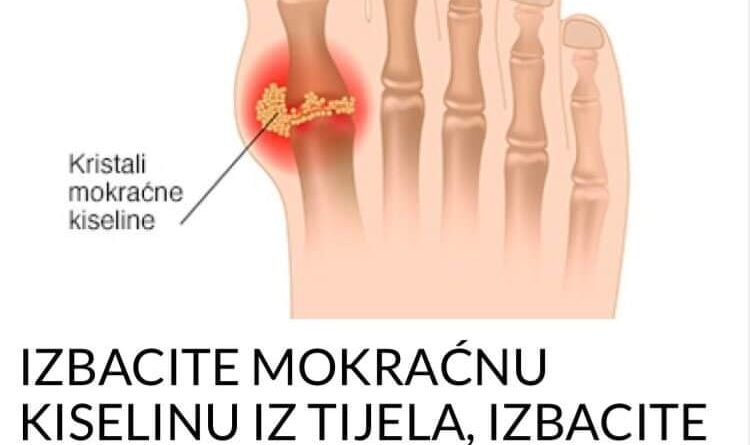 IZBACITE MOKRAĆNU KISELINU IZ TIJELA, IZBACITE GIHT: 3 narodna lijeka koja provjereno djeluju, EVO ŠTA ĆE VAM POMOĆI! (RECEPT)